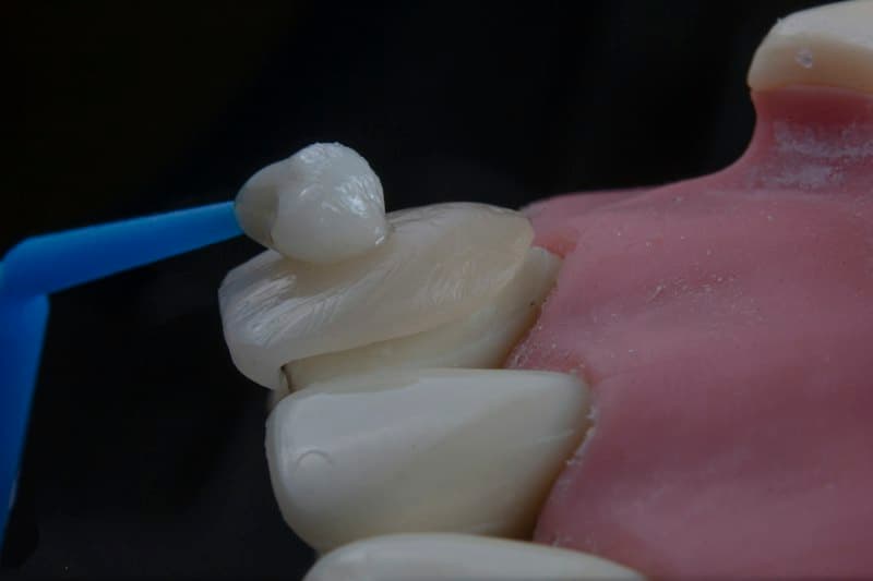 Rehabilitación Oral & Coronas de Zirconio