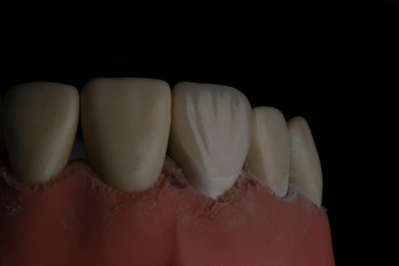 Periodontitis